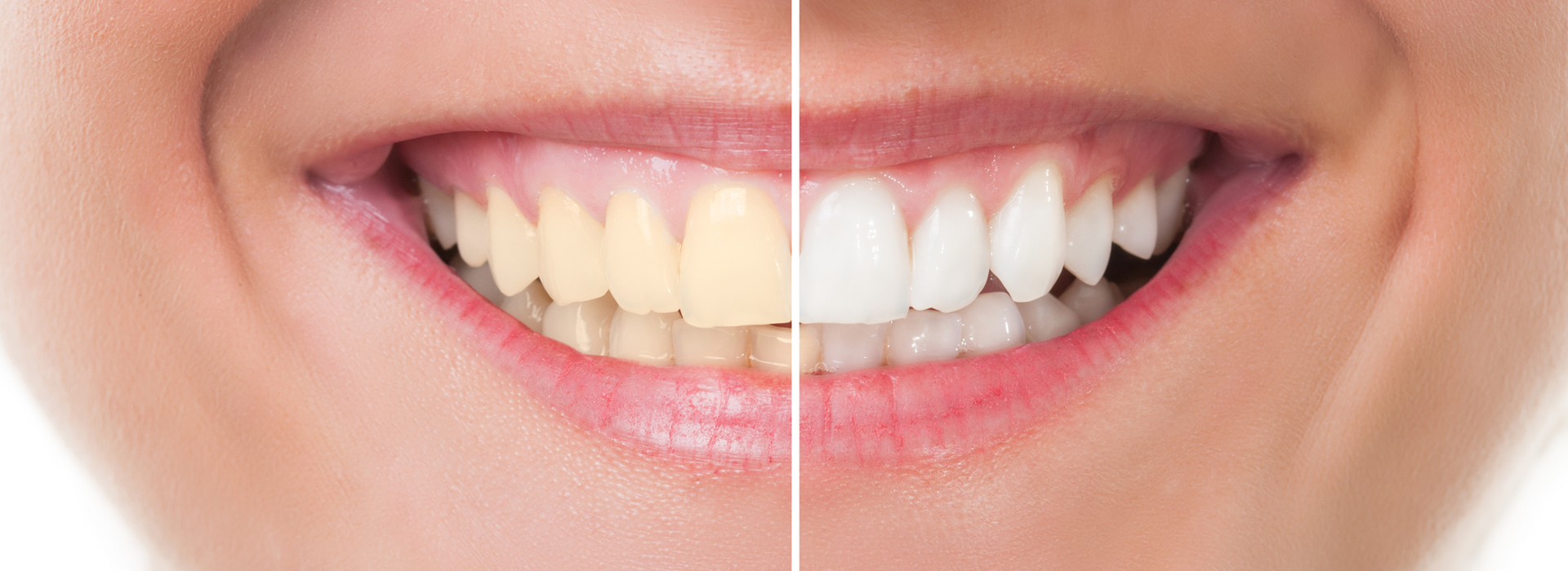 Tooth Whitening